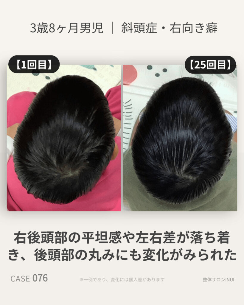 3歳8ヶ月男児の斜頭症による後頭部左右差