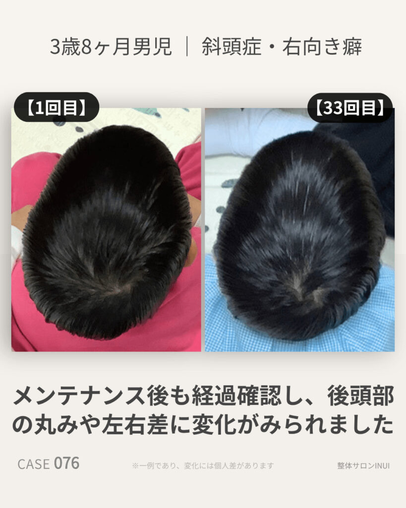 3歳8ヶ月男児の斜頭症による後頭部左右差