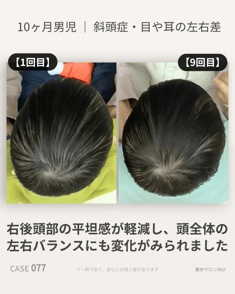 10ヶ月男児の斜頭症ビフォーアフター比較