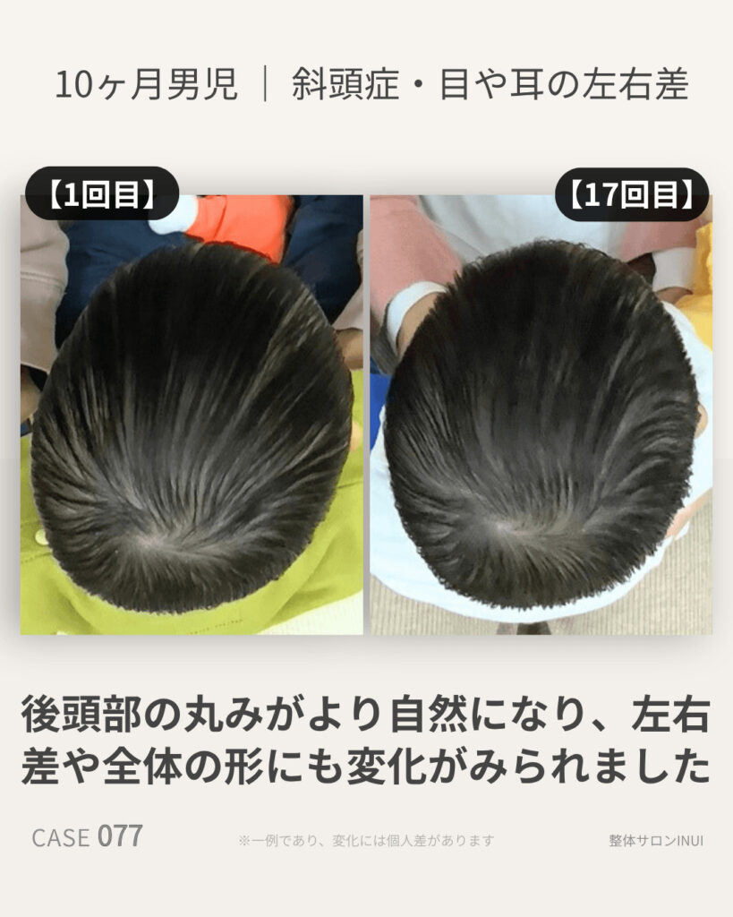 10ヶ月男児の斜頭症ビフォーアフター比較
