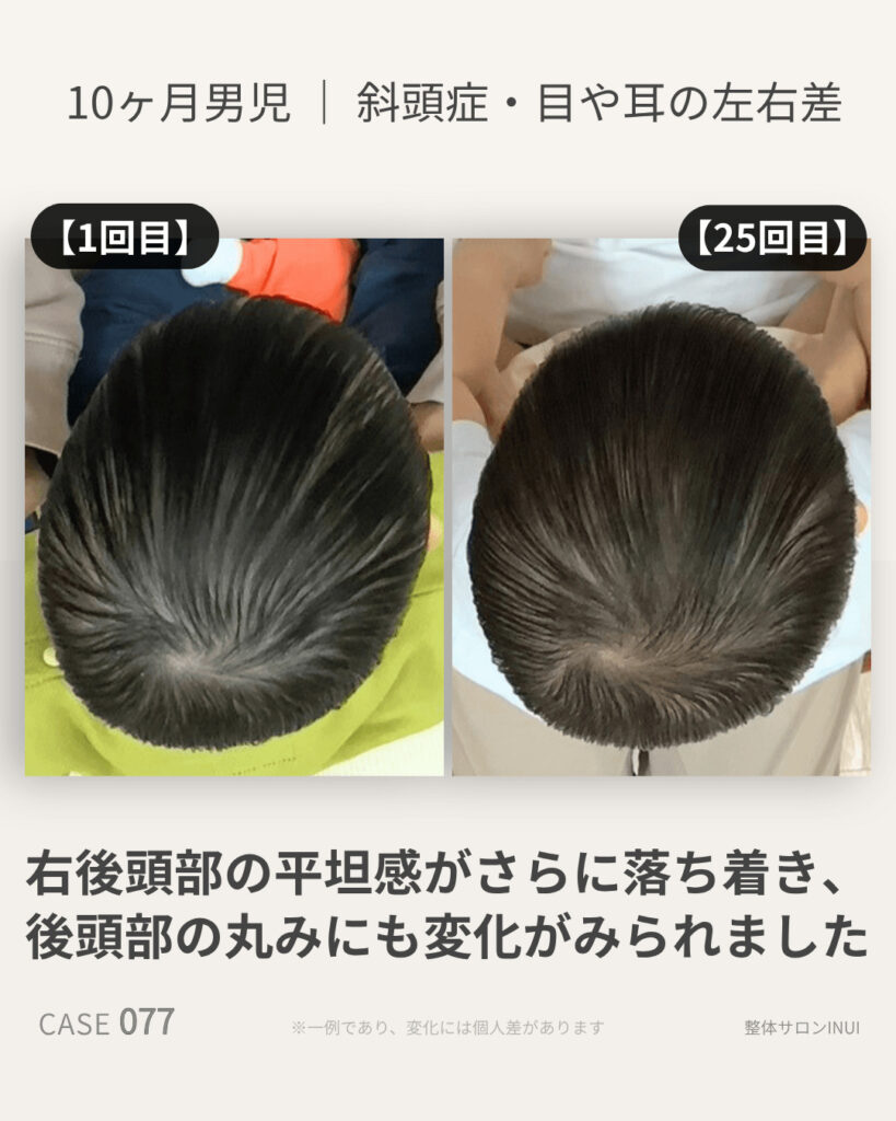 10ヶ月男児の斜頭症ビフォーアフター比較