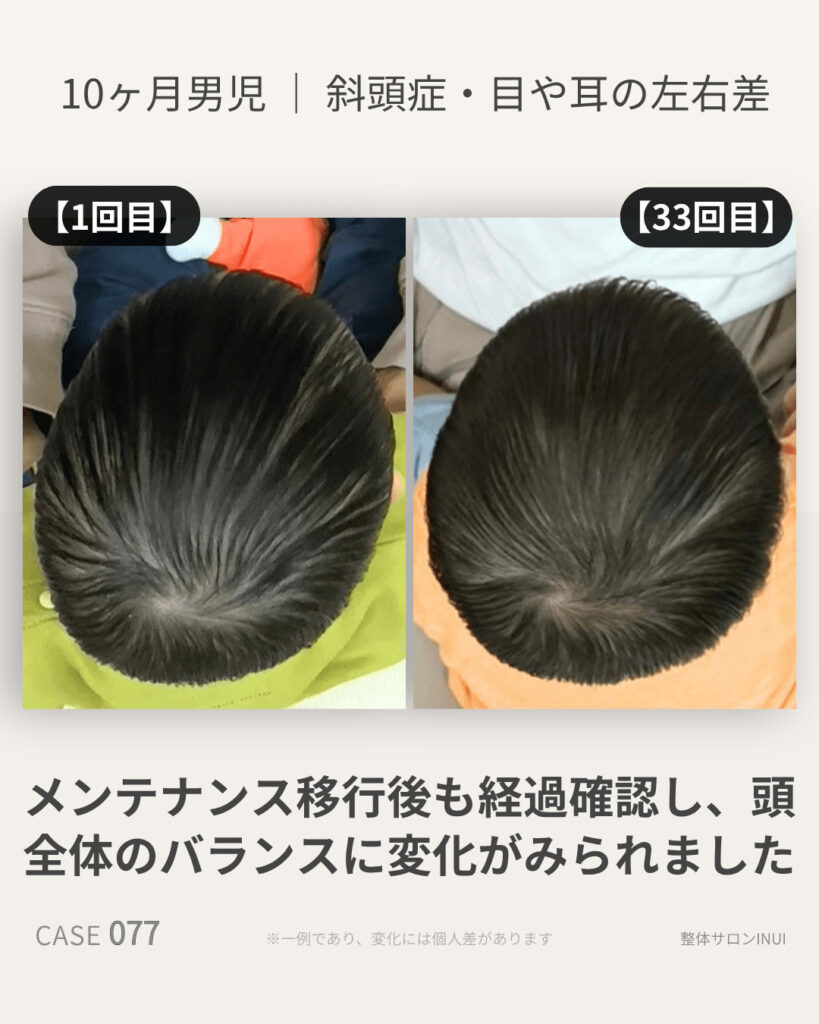 10ヶ月男児の斜頭症ビフォーアフター比較