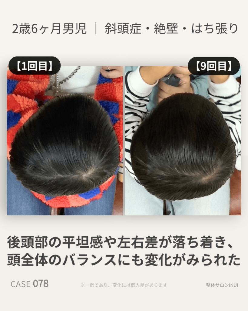2歳6ヶ月男児の斜頭症ビフォーアフター比較