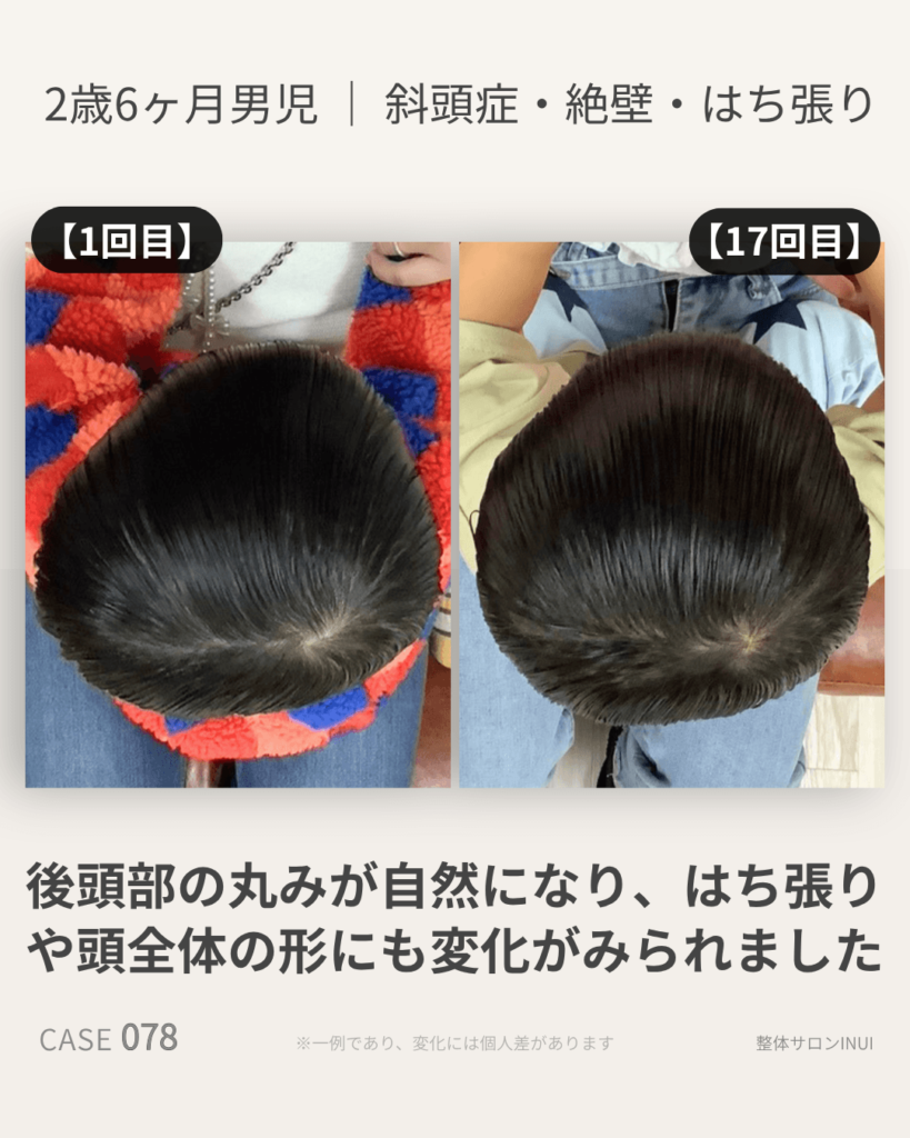 2歳6ヶ月男児の斜頭症ビフォーアフター比較