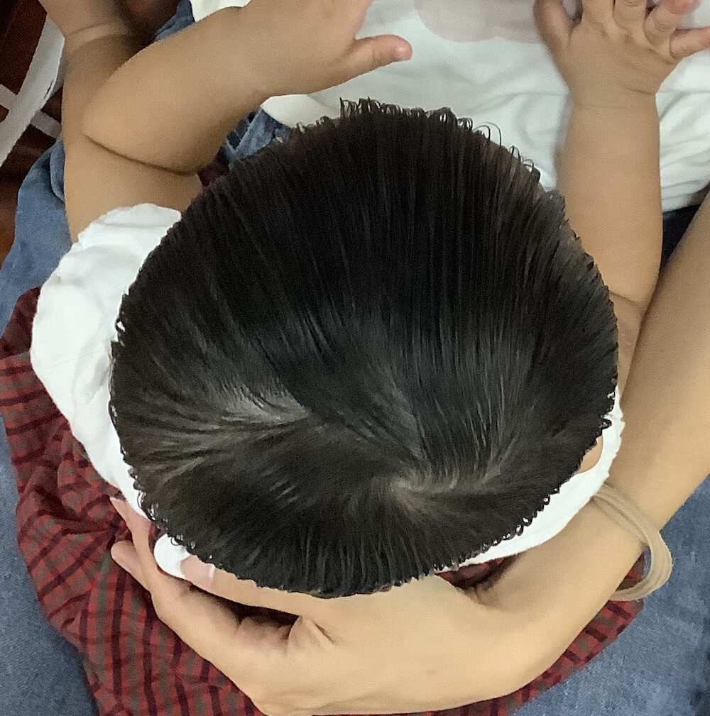 生後7ヶ月女児の斜頭症による後頭部左右差