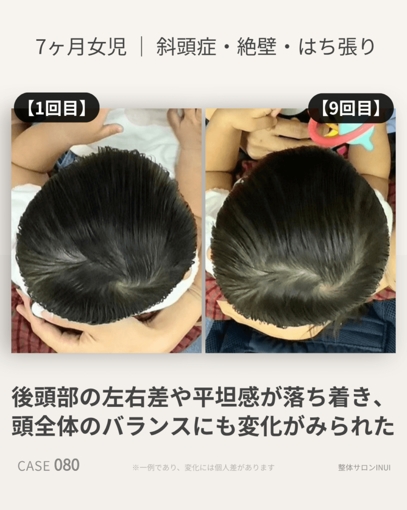 生後7ヶ月女児の斜頭症ビフォーアフター比較