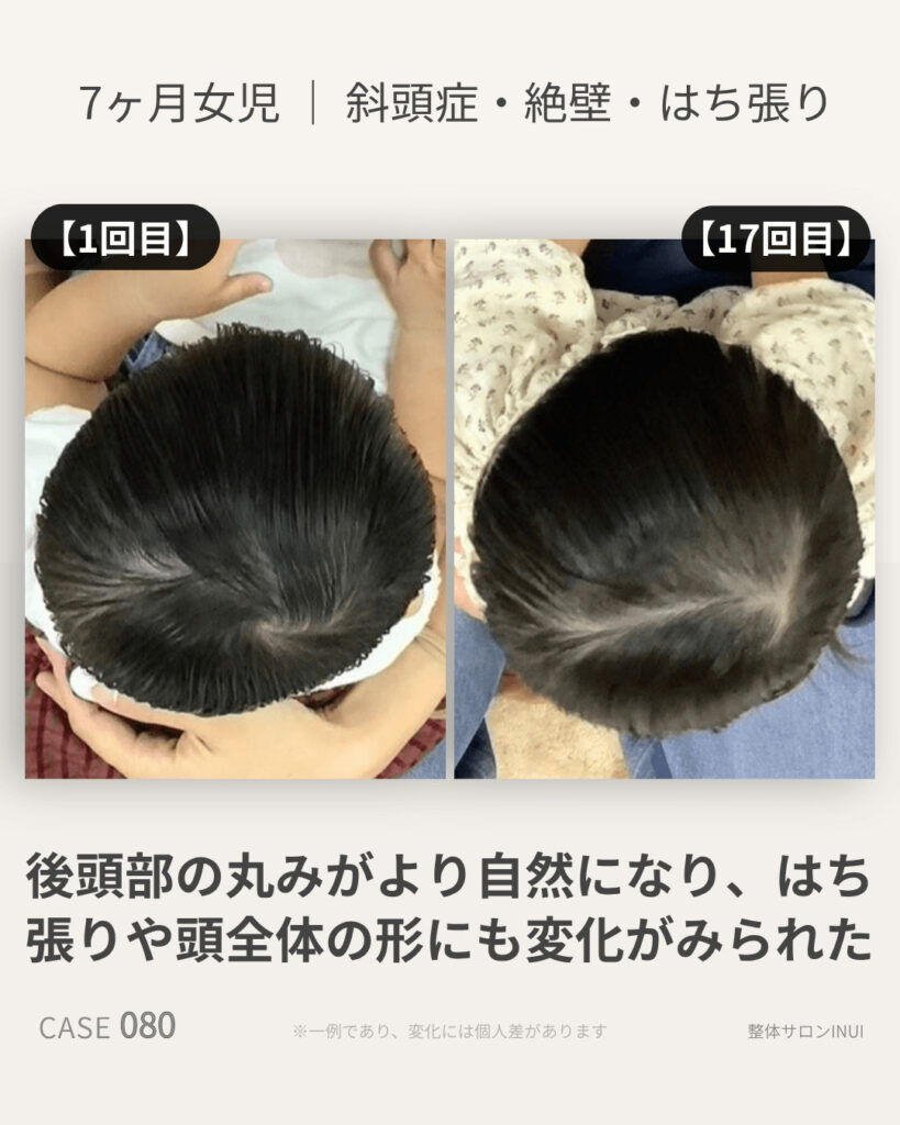 生後7ヶ月女児の斜頭症ビフォーアフター比較