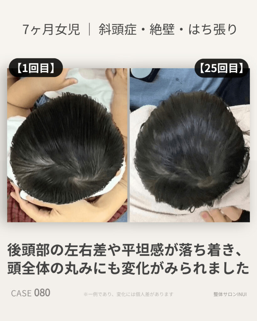 生後7ヶ月女児の斜頭症ビフォーアフター比較