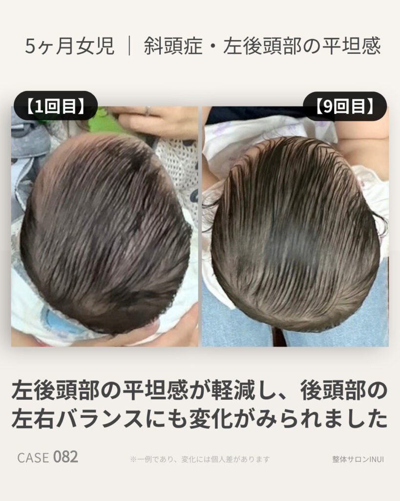 5ヶ月女児の斜頭症ビフォーアフター比較