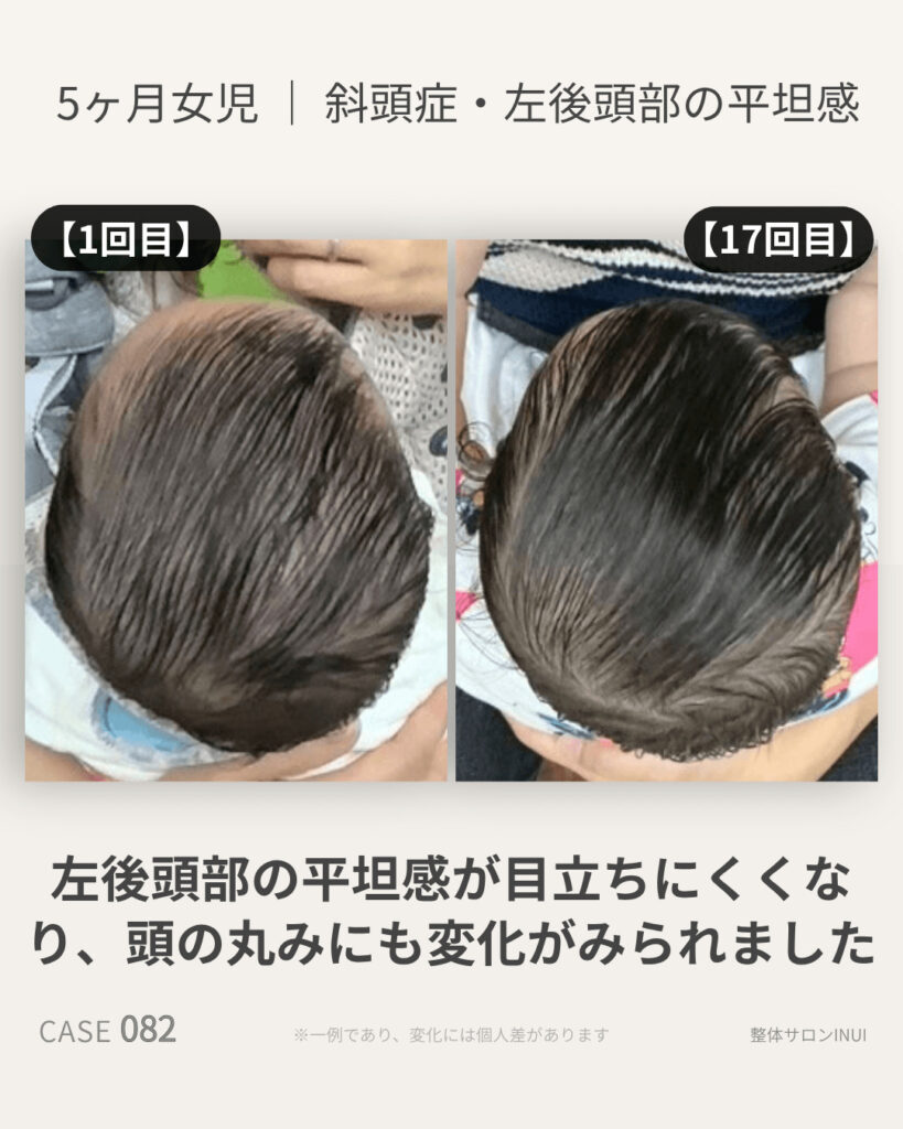 5ヶ月女児の斜頭症ビフォーアフター比較