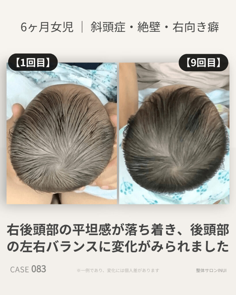 6ヶ月女児の斜頭症ビフォーアフター比較