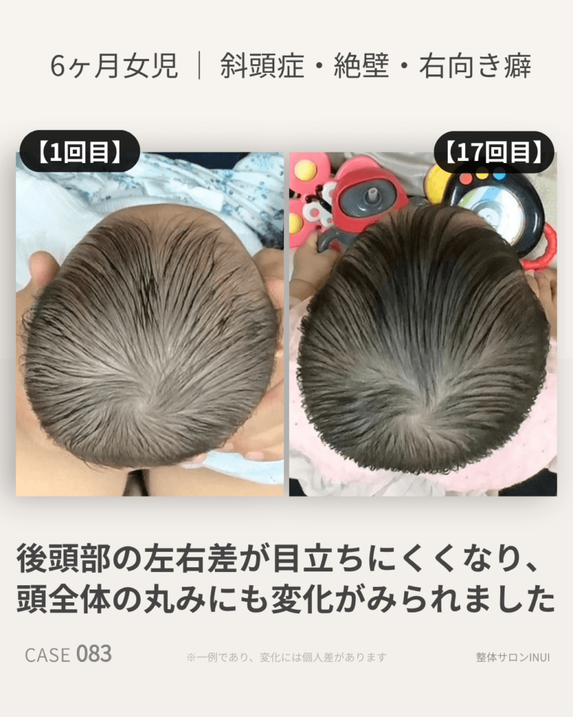 6ヶ月女児の斜頭症ビフォーアフター比較