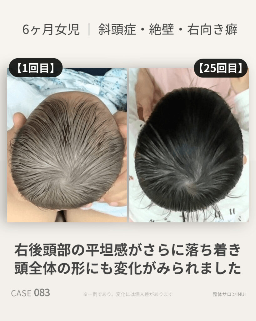 6ヶ月女児の斜頭症ビフォーアフター比較