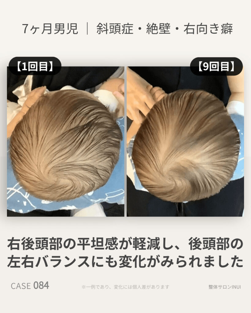 生後7ヶ月男児の斜頭症ビフォーアフター比較