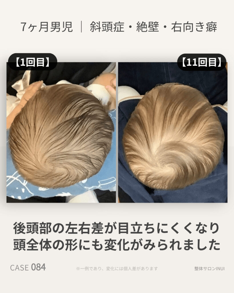 生後7ヶ月男児の斜頭症ビフォーアフター比較