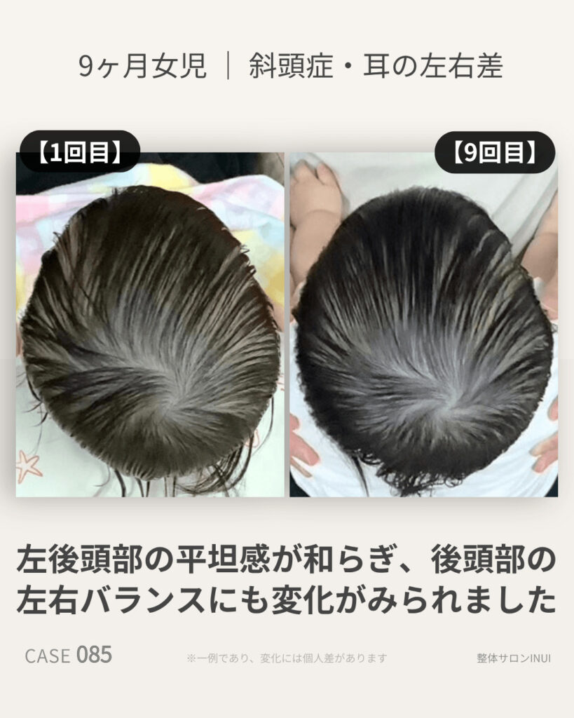 9ヶ月女児の斜頭症ビフォーアフター比較