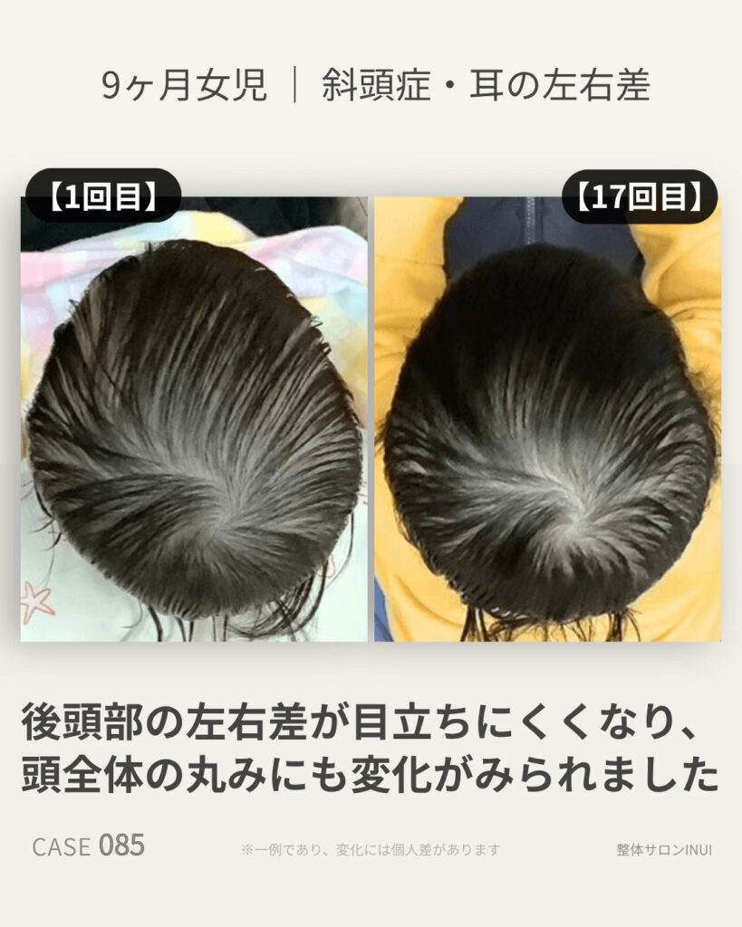 9ヶ月女児の斜頭症ビフォーアフター比較