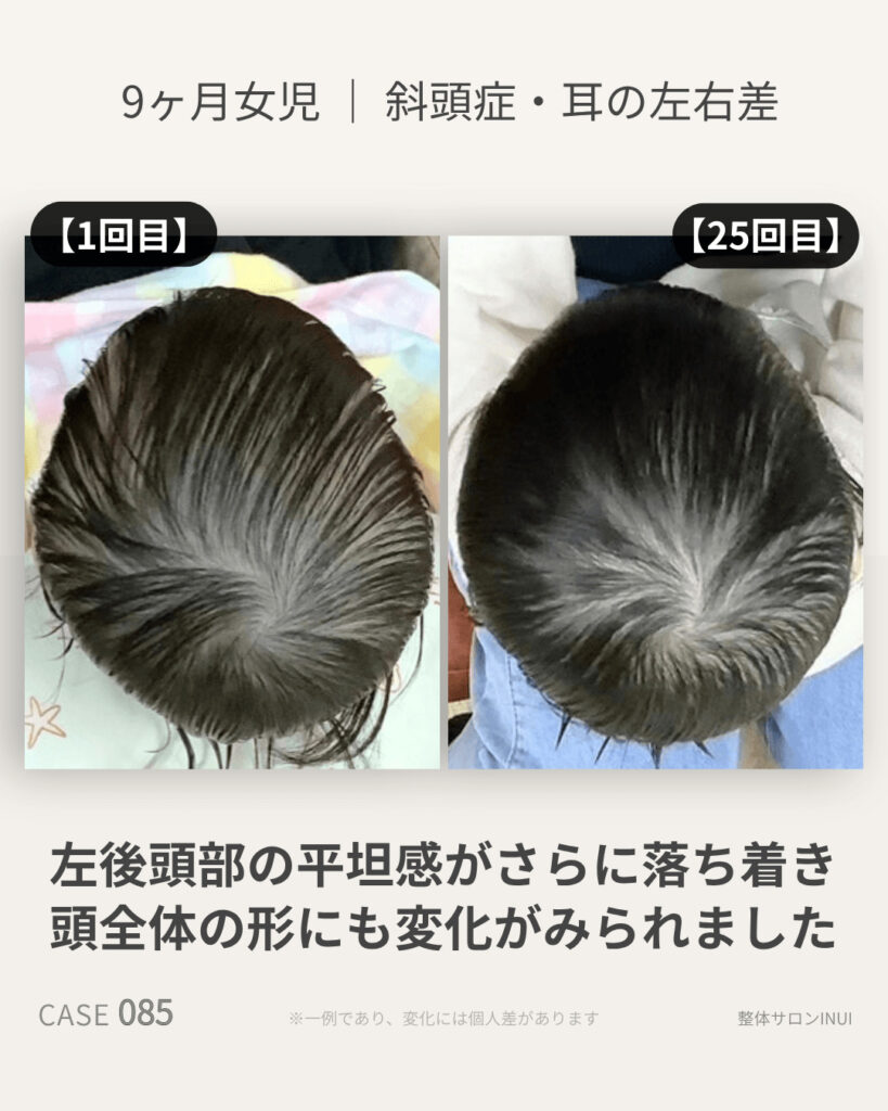 9ヶ月女児の斜頭症ビフォーアフター比較