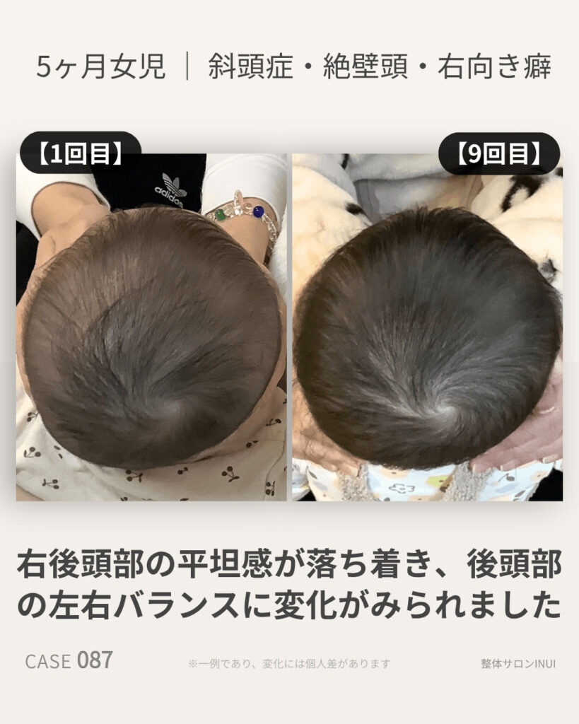 5ヶ月女児の斜頭症ビフォーアフター比較