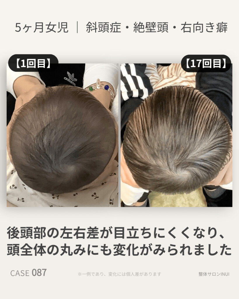 5ヶ月女児の斜頭症ビフォーアフター比較