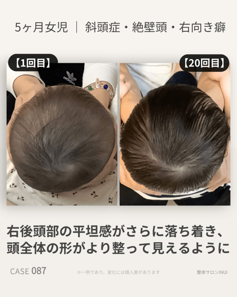 5ヶ月女児の斜頭症ビフォーアフター比較