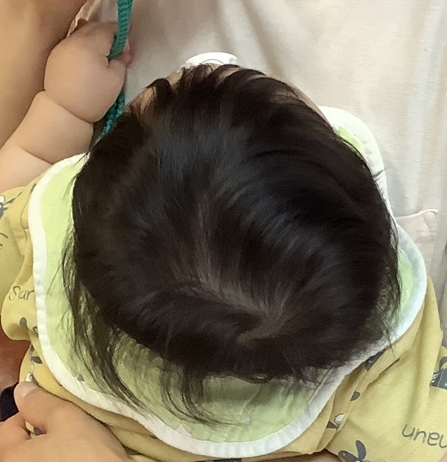 生後9ヶ月男児の斜頭症による後頭部左右差