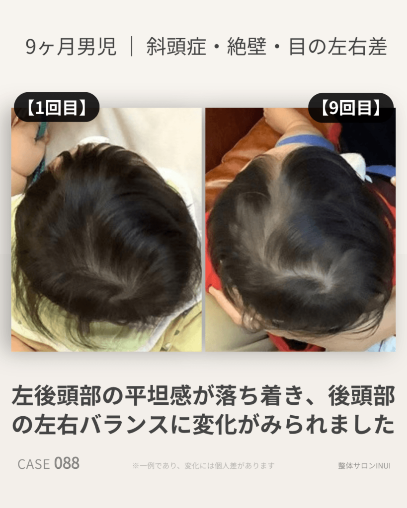 生後9ヶ月男児の斜頭症ビフォーアフター比較