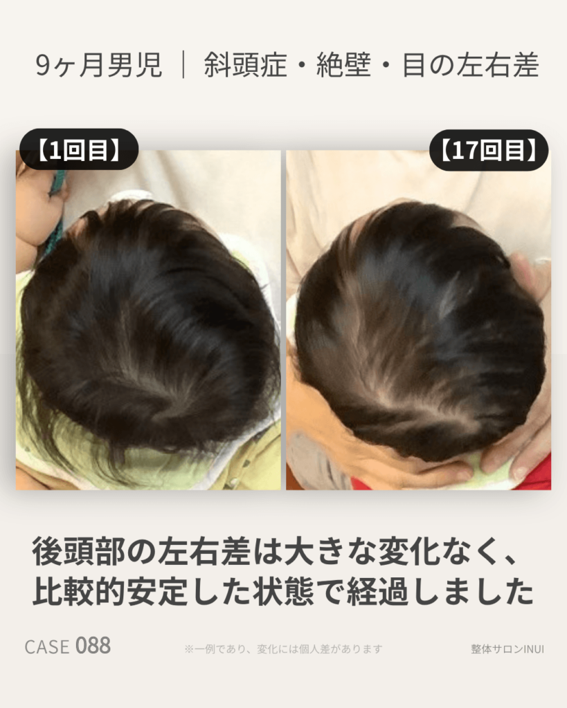 生後9ヶ月男児の斜頭症ビフォーアフター比較