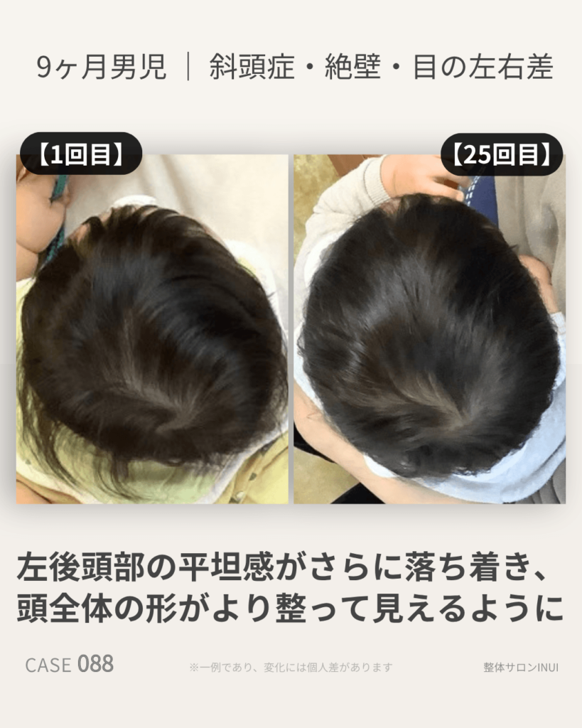 生後9ヶ月男児の斜頭症ビフォーアフター比較
