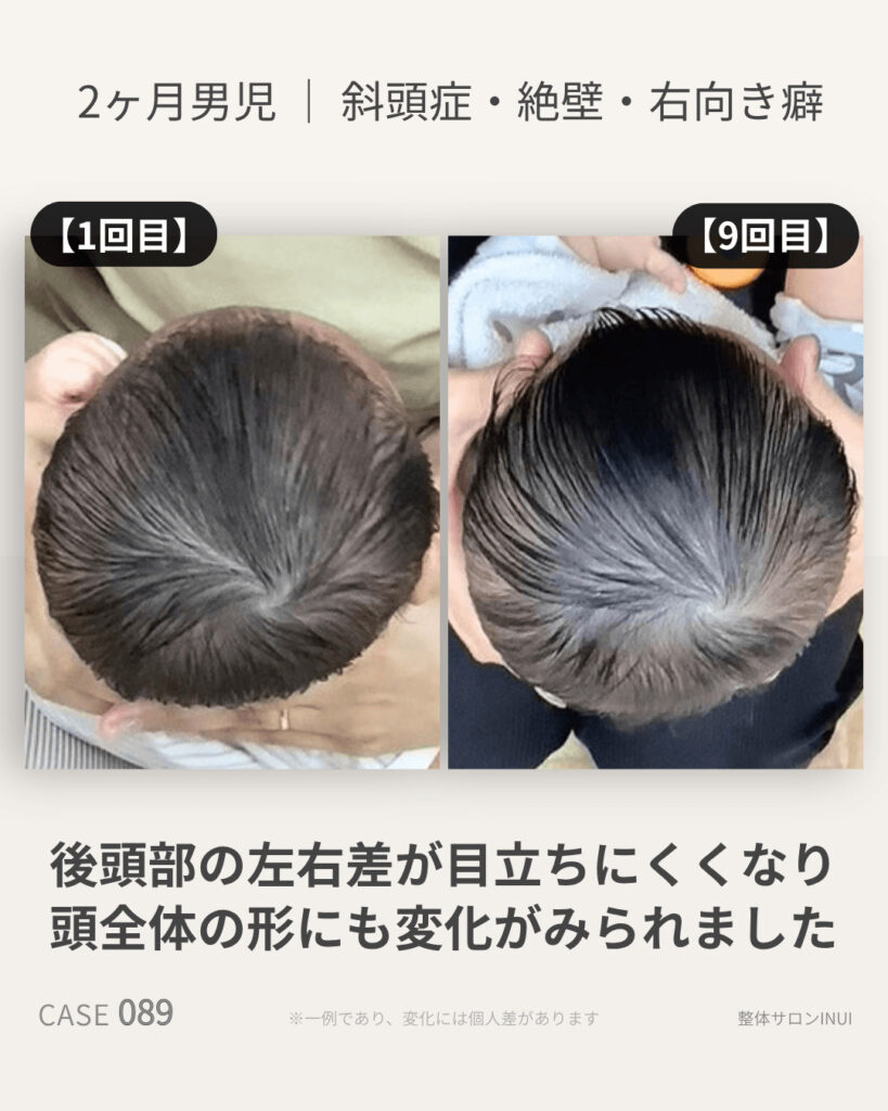 生後2ヶ月男児の斜頭症ビフォーアフター比較