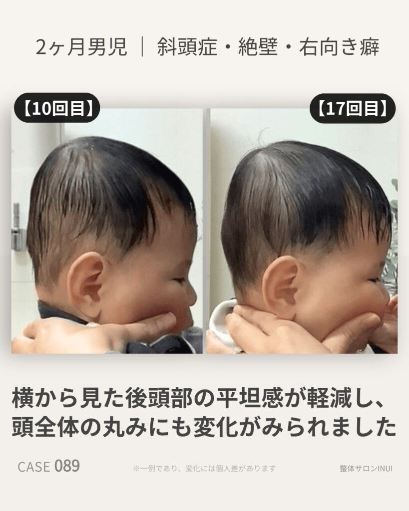 生後2ヶ月男児の斜頭症ビフォーアフター比較