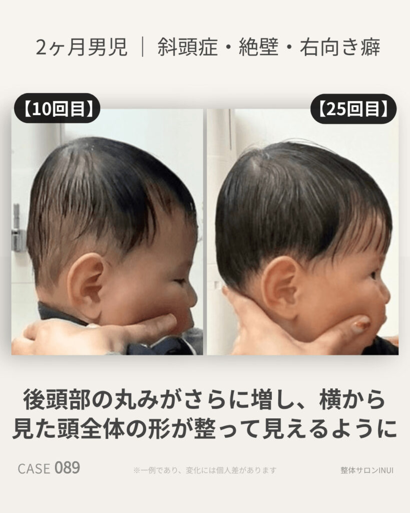 生後2ヶ月男児の斜頭症ビフォーアフター比較