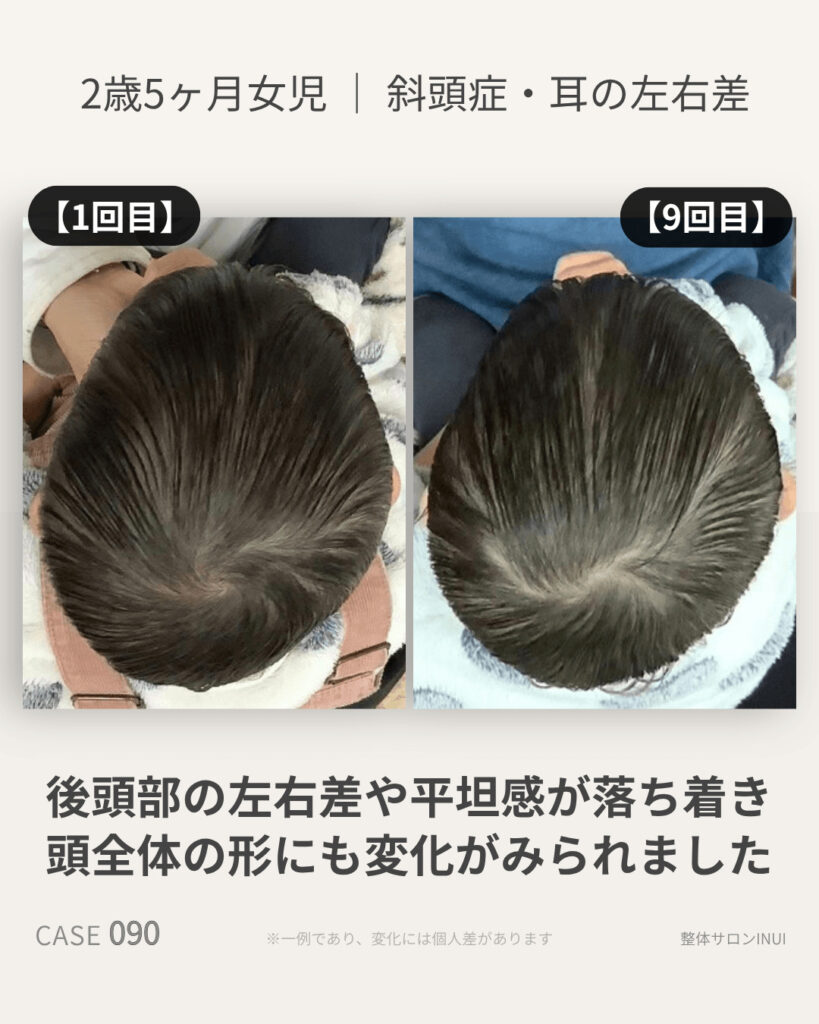 2歳5ヶ月女児の斜頭症ビフォーアフター比較