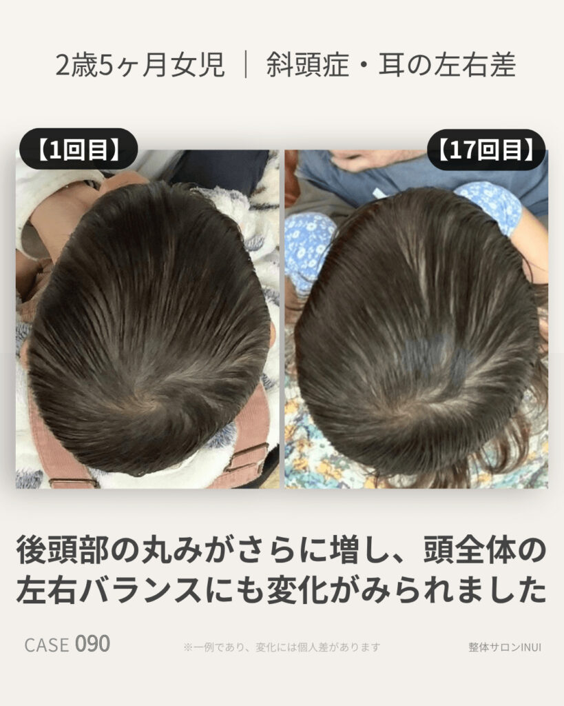 2歳5ヶ月女児の斜頭症ビフォーアフター比較