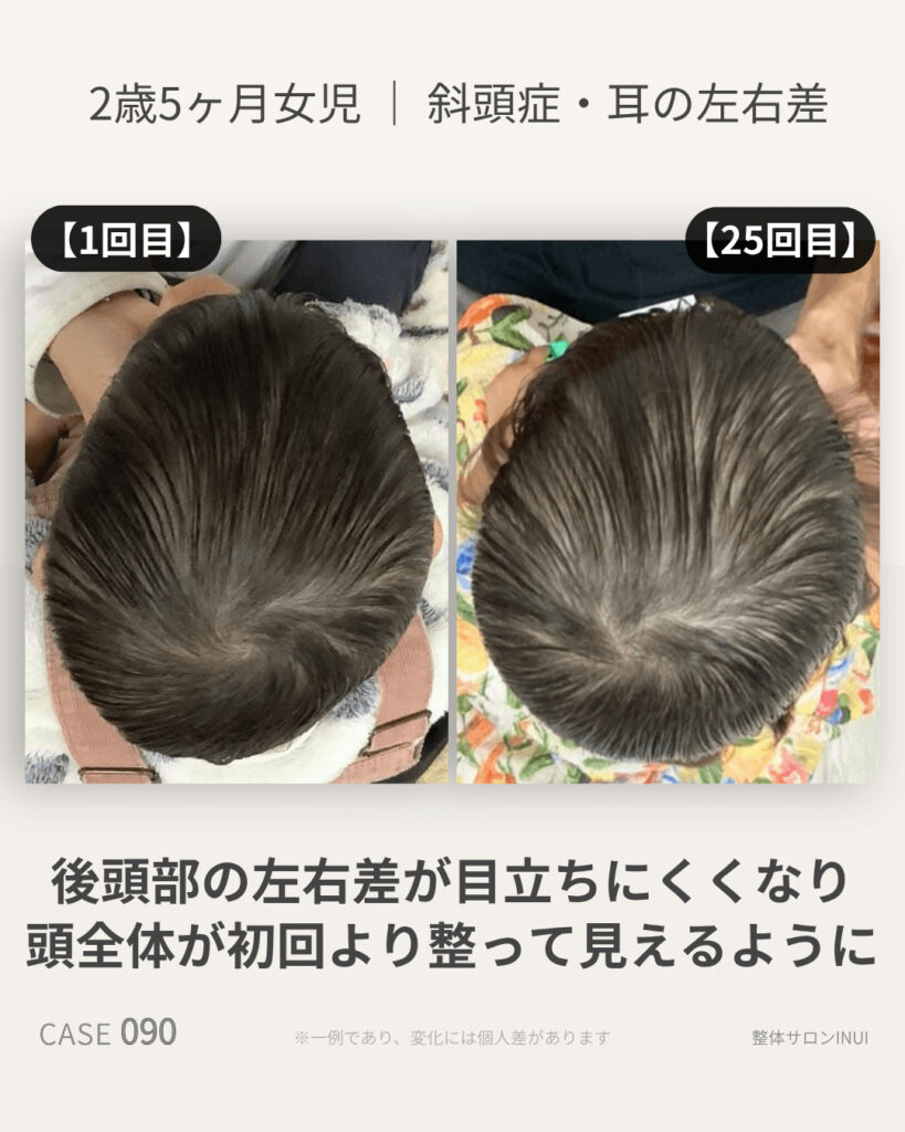 2歳5ヶ月女児の斜頭症ビフォーアフター比較