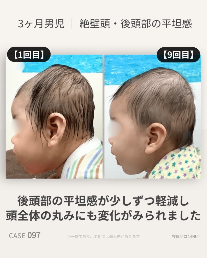 3ヶ月男児の絶壁頭ビフォーアフター比較