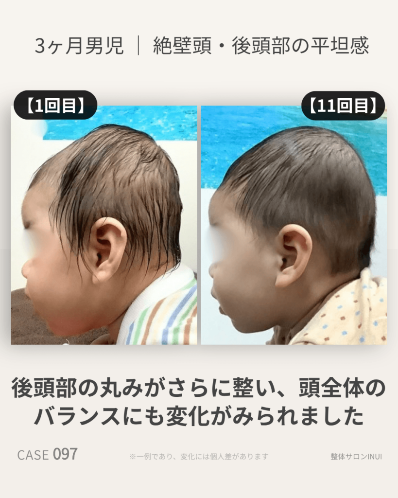 3ヶ月男児の絶壁頭ビフォーアフター比較