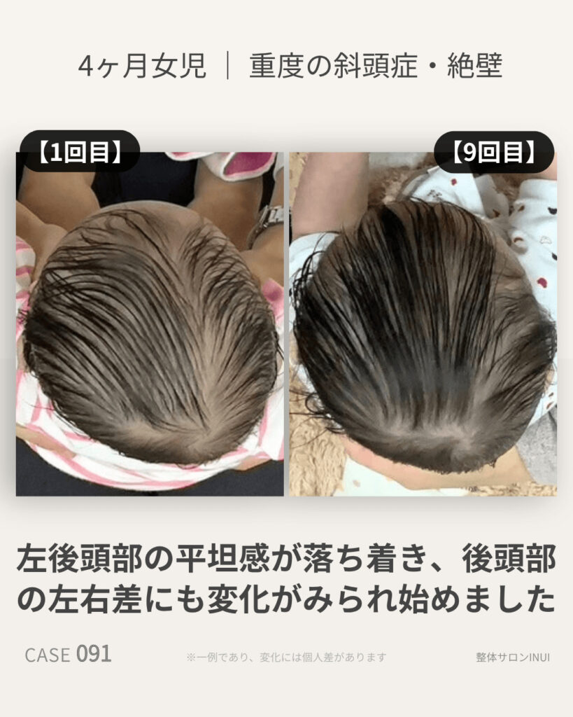 4ヶ月女児の斜頭症ビフォーアフター比較