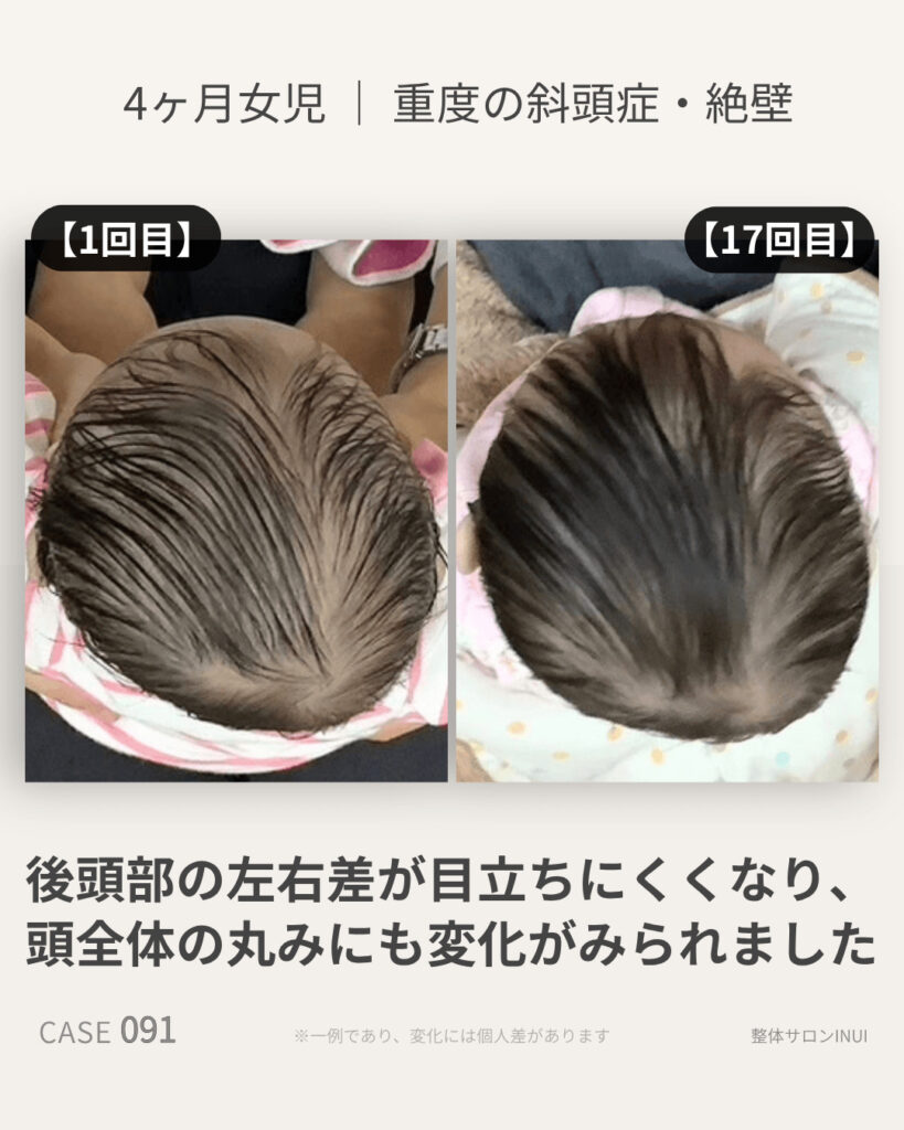 4ヶ月女児の斜頭症ビフォーアフター比較