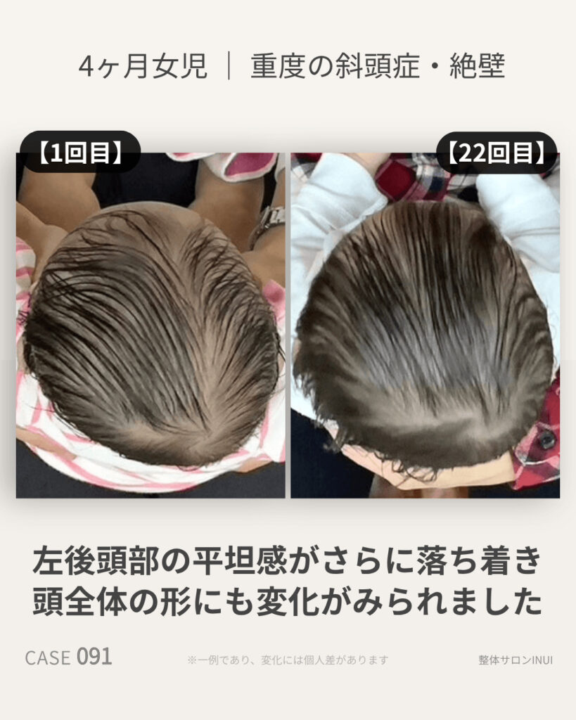 4ヶ月女児の斜頭症ビフォーアフター比較