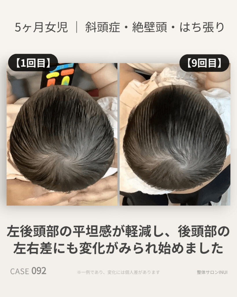 5ヶ月女児の斜頭症ビフォーアフター比較