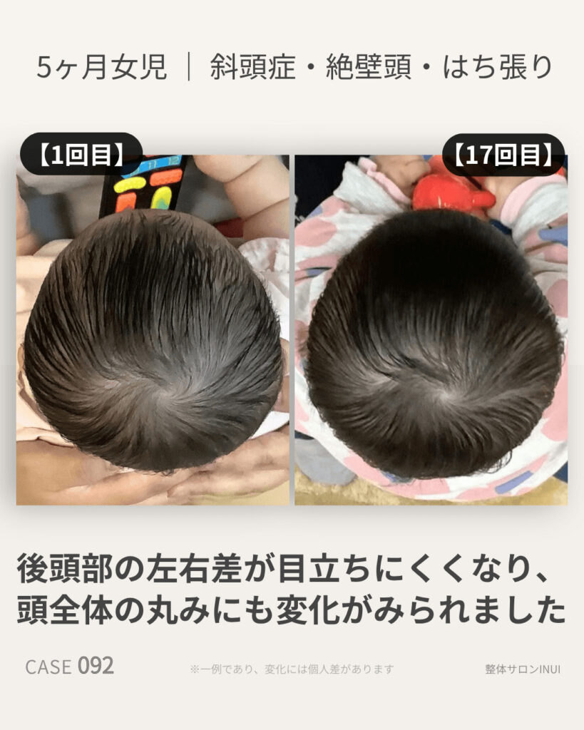 5ヶ月女児の斜頭症ビフォーアフター比較
