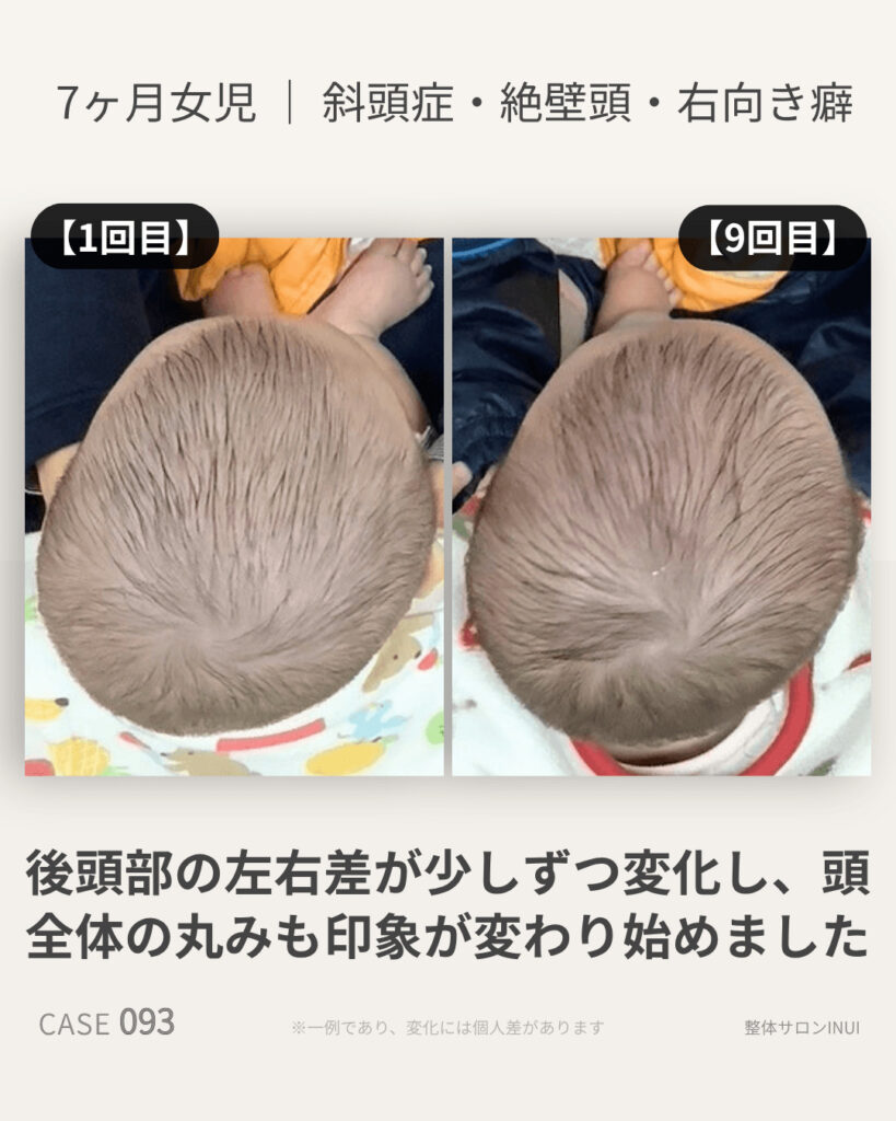 7ヶ月女児の斜頭症ビフォーアフター比較