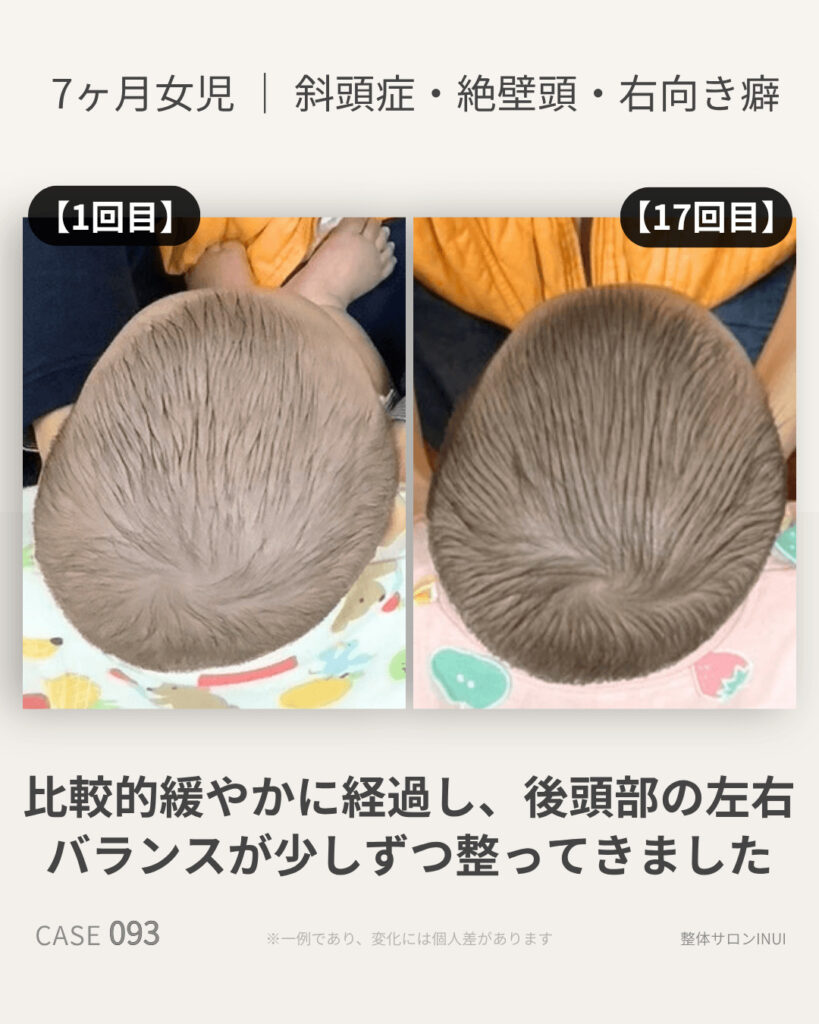 7ヶ月女児の斜頭症ビフォーアフター比較