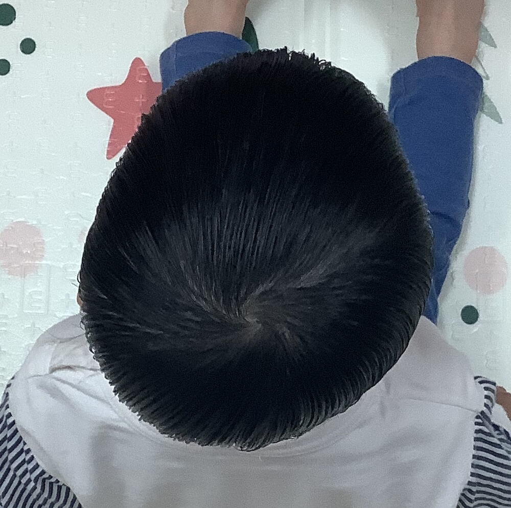 3歳3ヶ月男児の斜頭症による後頭部左右差