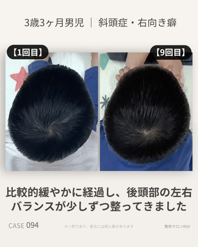 3歳3ヶ月男児の斜頭症ビフォーアフター比較