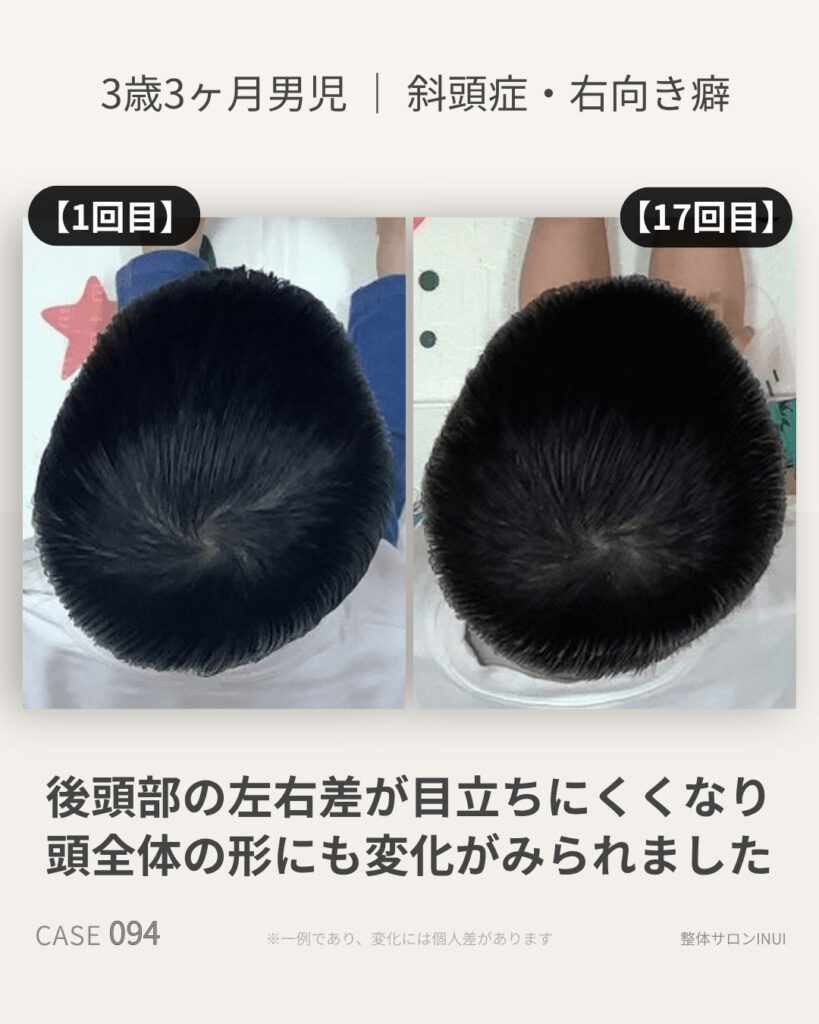 3歳3ヶ月男児の斜頭症ビフォーアフター比較