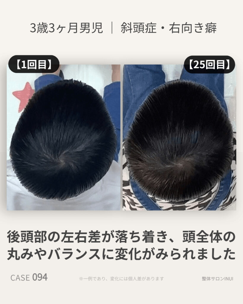 3歳3ヶ月男児の斜頭症ビフォーアフター比較