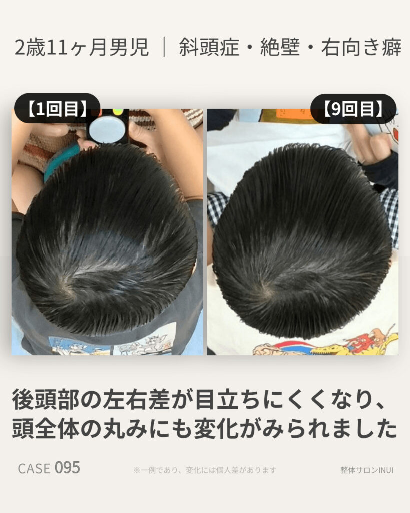2歳11ヶ月男児の斜頭症ビフォーアフター比較