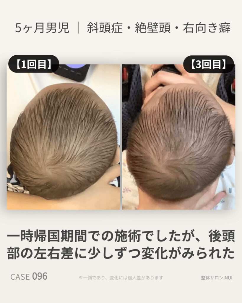 生後5ヶ月男児の斜頭症ビフォーアフター比較